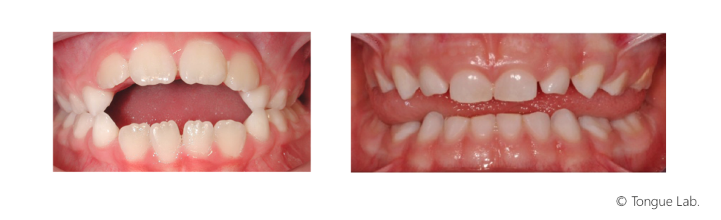 Exemples de malocclusions.