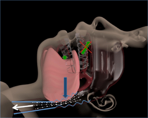 L'affaissement de la langue provoque un collapsus partiel ou total du pharynx.